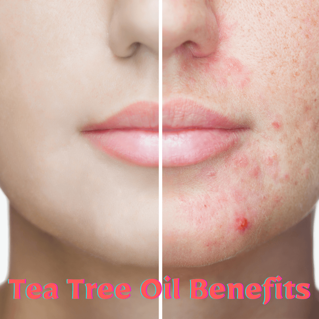 Tea Tree Oil Benefits - My Life Tea