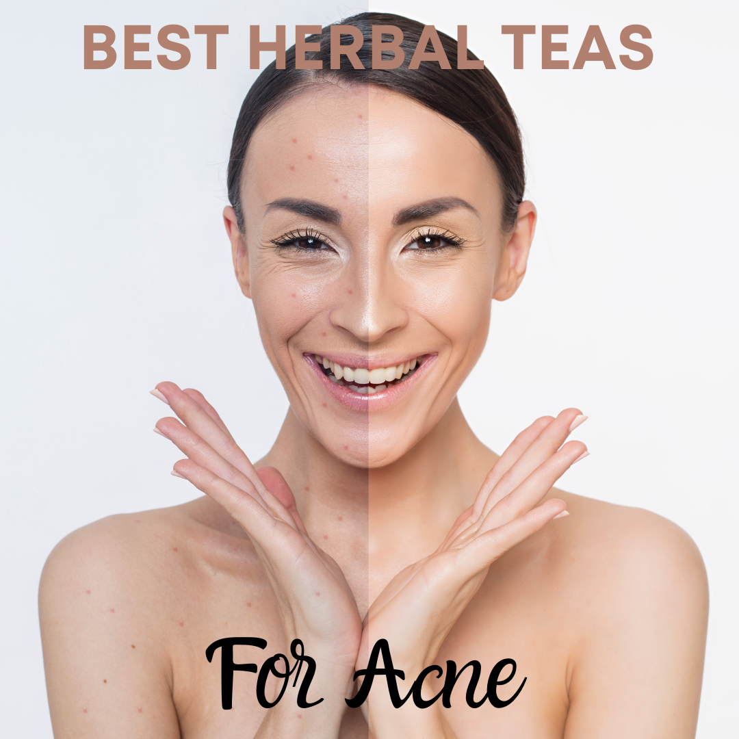 Best Herbal Teas For Acne - My Life Tea